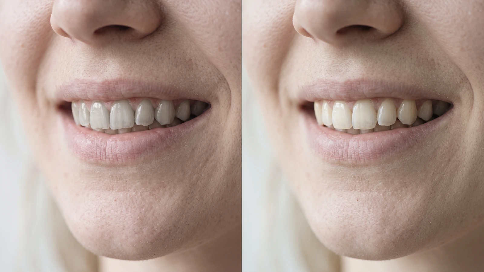 Lächeln vor und nach sechs Keramikveneers an den oberen Frontzähnen
